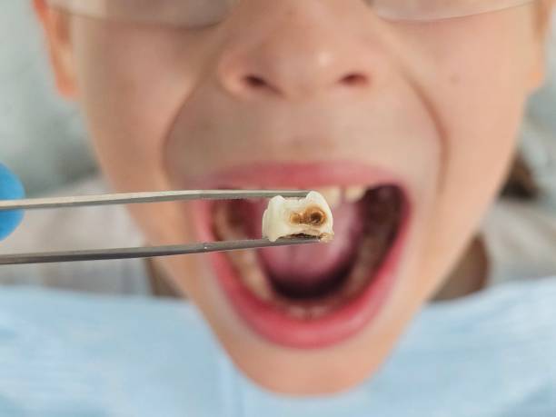 Best Emergency Treatment for Oral Infections in Bishop, TX