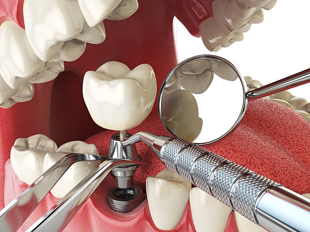 Best Broken or Chipped Tooth Repair in Bishop, TX